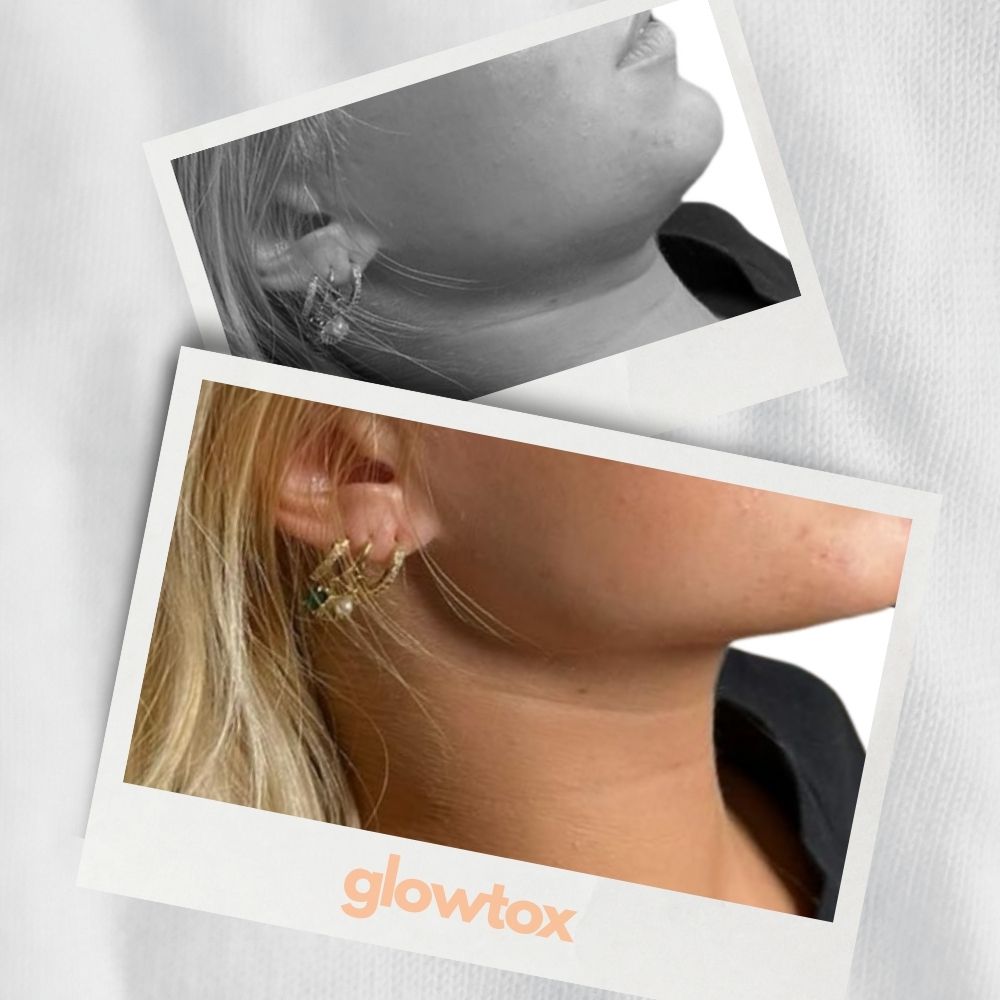 Ergebnis Foto Jawline blonde Frau glowtox